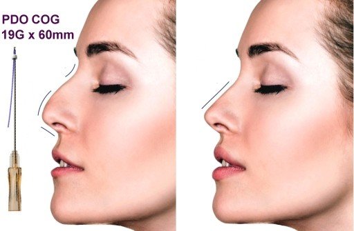 PDO Fäden,Nasenlift,Nasenkorrektur COG 19G X 60mm L-Typ Stumpf - Image 2