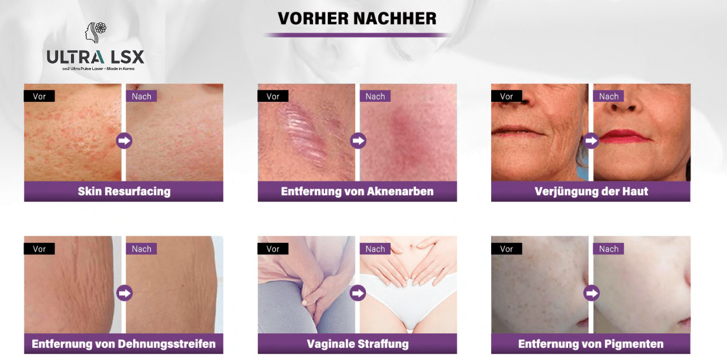 CO2 UltraPulse Laser 70W - Imagen 5