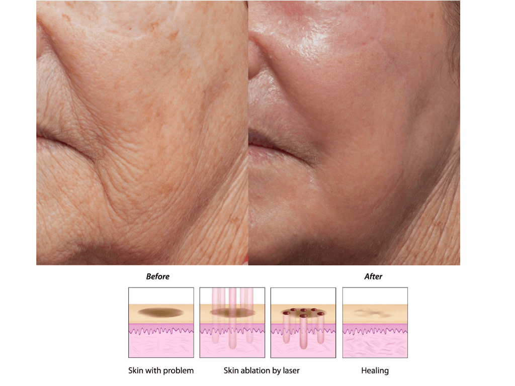 CO2 UltraPulse Laser 70W - Imagen 3