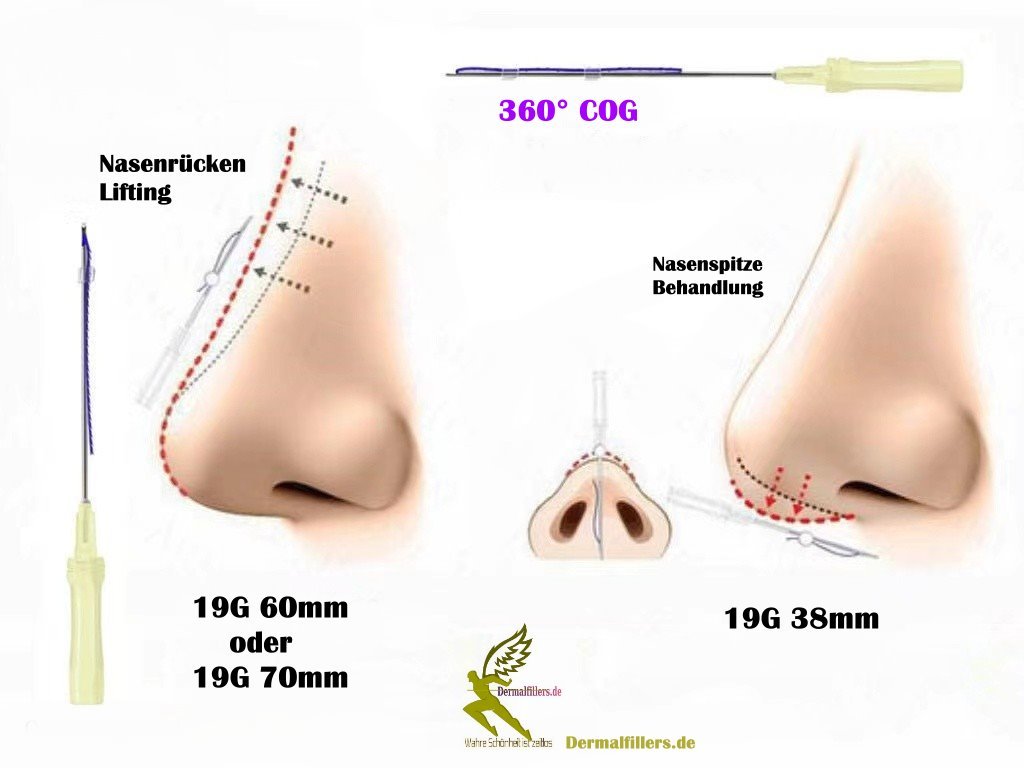 PDO Fäden,Nasenlift,Nasenkorrektur COG 19G X 60mm L-Typ Stumpf - Image 3