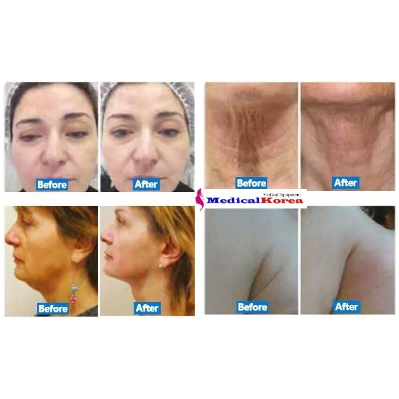 HiFu 7 D Gerät Profi High Intensity Focused Ultrasound - Afbeelding 7